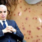 وزير الصحة مرض بوحمرون