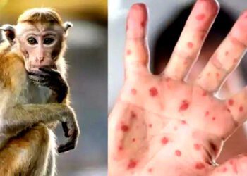 ما هو مرض جذري القردة