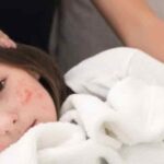 مرض بوحمرون