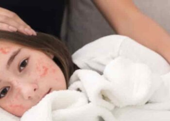 مرض بوحمرون