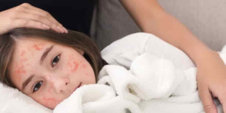 مرض بوحمرون