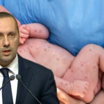 حصيلة مقلقة لمرض بوحمرون بالمغرب: وزير الصحة يكشف عن 107 حالات وفاة وأسباب الانتشار
