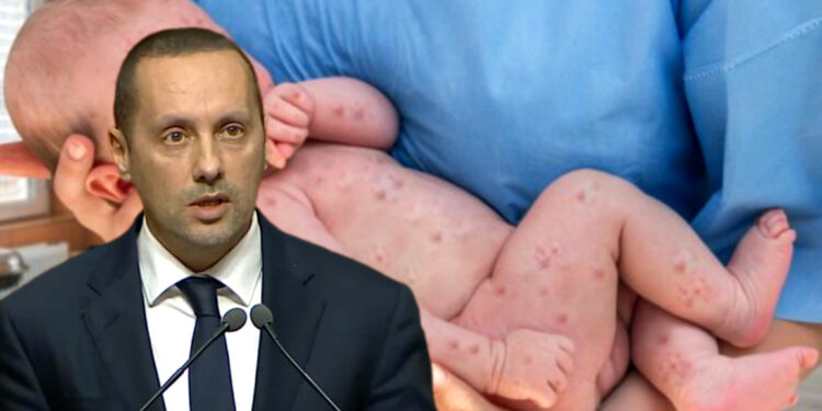 حصيلة مقلقة لمرض بوحمرون بالمغرب: وزير الصحة يكشف عن 107 حالات وفاة وأسباب الانتشار