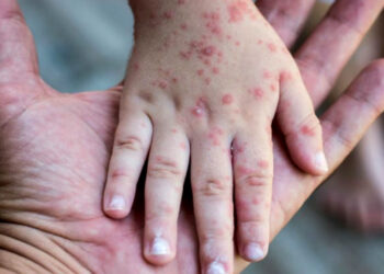 بوحمرون المغرب.. إطلاق حملة تلقيح استدراكية وأمراض أخرى في هذا التاريخ