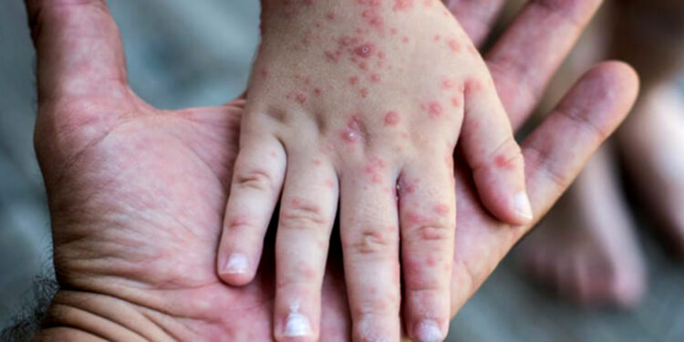 بوحمرون المغرب.. إطلاق حملة تلقيح استدراكية وأمراض أخرى في هذا التاريخ